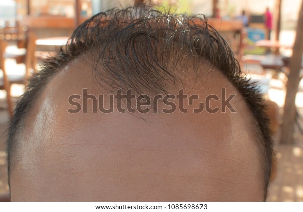 Male Head Hair Loss Symptoms Front Stock Photo Edit Now 1085698673