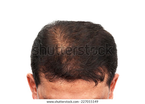 Male Head Hair Loss Symptoms Front Stock Photo Edit Now 227015149
