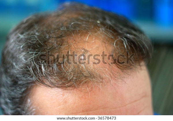 Male Head Hair Loss Symptoms Front Stock Photo 36578473 | Shutterstock