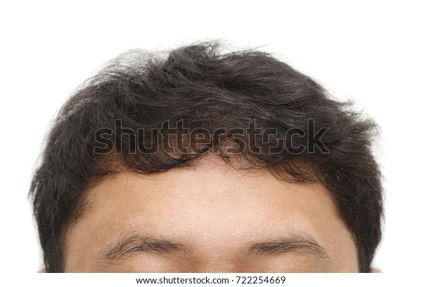 Male Head Hair Loss Symptoms Front Stock Photo Edit Now 722254669