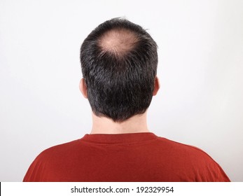 male head with thinning hair or alopecia