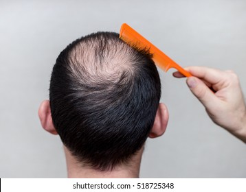 Male Head With Thinning Hair Or Alopecia