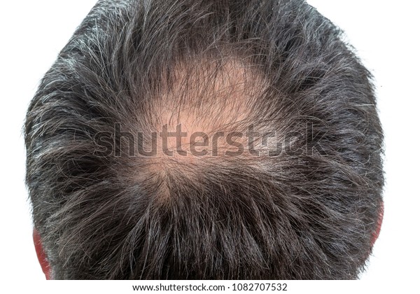 Male Head Thinning Hair Alopecia Stock Photo Edit Now 1082707532