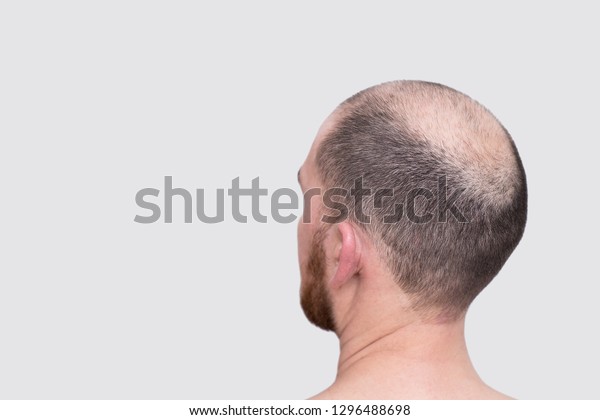Male Head Thinning Hair Alopecia Stock Photo Edit Now 1296488698