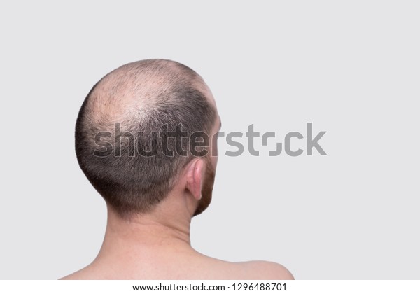 Male Head Thinning Hair Alopecia Stock Photo Edit Now 1296488701
