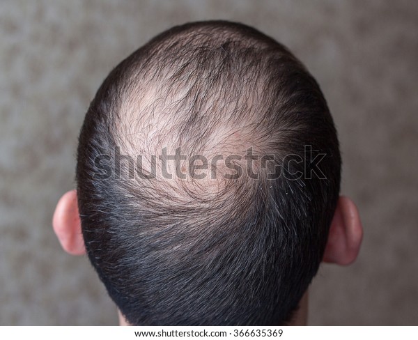 Male Head Thinning Hair Alopecia Healthcare Medical Stock Image