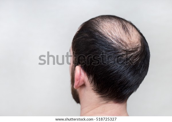 Male Head Thinning Hair Alopecia Stock Photo Edit Now 518725327