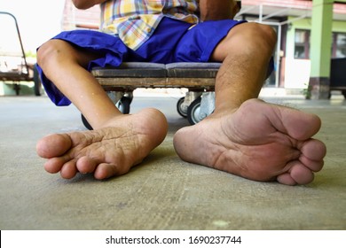 Male Leg Has Polio Both Feet And Legs Are Not The Same Size. Sitting On A Wheeled Vehicle