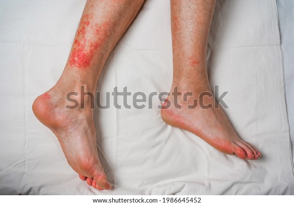 Male Leg Itching Red Rash Caused Stock Photo 1986645452 Shutterstock