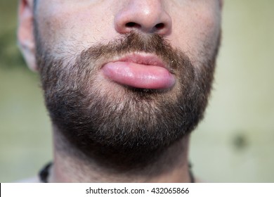 1,339 Swollen lip Images, Stock Photos & Vectors | Shutterstock