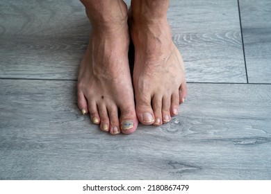 male man feet close up, nail fungus, skin and nail infection, toe mycosis, treatment needed, fungal infection concept, onychomycosis 