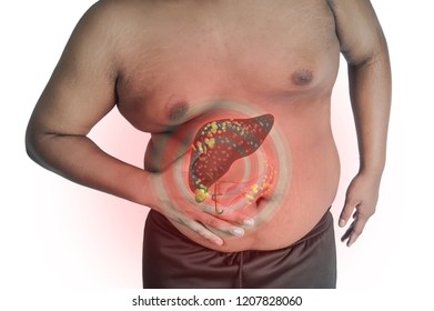 Male Obesity And Fatty Liver