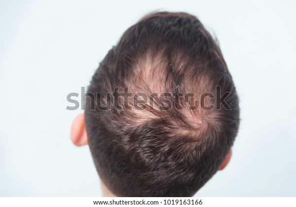 Male Pattern Baldness Hair Loss Early Stock Image Download Now