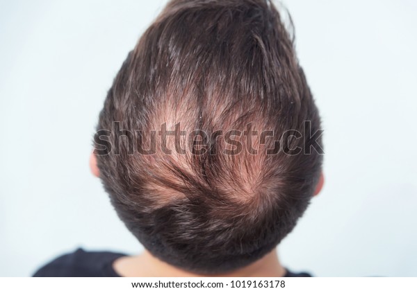 Male Pattern Baldness Hair Loss Early Stock Photo Edit Now