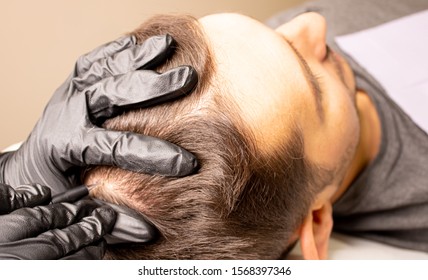 Male trichopigmentation service. Young man laying on the back on the esthetician table. Master hands in a black gloves holding the permanent makeup machine with the needle and touching mans hair.