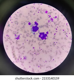 malignant cell found in acitic fluid 