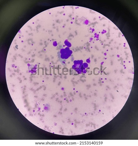 malignant cell found in acitic fluid 