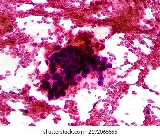 Malignant cells, bronchoalveolar lavage(BAL) adenocarcinoma, show cellular material composed of atypical epithelial cells, acute and chronic inflammatory cells. Cytology test  - Shutterstock ID 2192065555