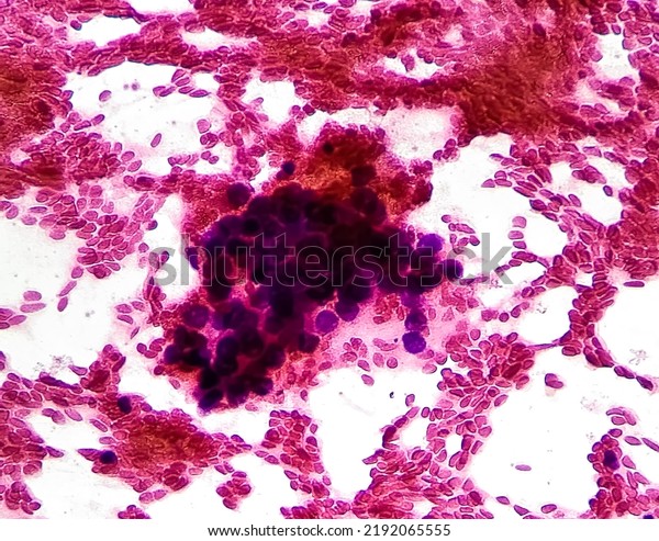 Malignant cells,\
bronchoalveolar lavage(BAL) adenocarcinoma, show cellular material\
composed of atypical epithelial cells, acute and chronic\
inflammatory cells. Cytology test\
