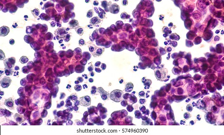 Malignant effusion (cancer cells): Pleural fluid cytology of lung (pulmonary) papillary adenocarcinoma, a type of non small cell carcinoma.  Pap stain.  