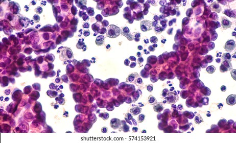 Malignant Effusion: Pleural Fluid Cytology Of Lung (pulmonary) Papillary Adenocarcinoma, A Type Of Non Small Cell Carcinoma.  Pap Stain.  