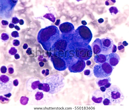 Malignant Effusion Pleural Fluid Cytology Lung Stock Photo (Edit Now