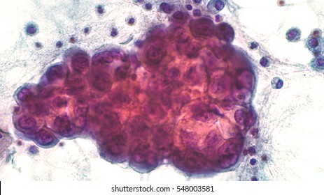 Malignant effusion: Pleural fluid pathology (cytology) of lung (pulmonary) adenocarcinoma, a type of non small cell cancer (carcinoma).  Pap stain.  