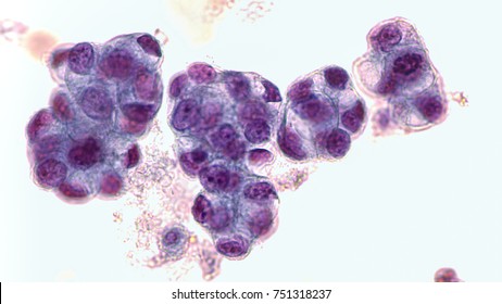 Malignant Fluid Cytology;   Malignant Cells Of Adenocarcinoma May Spread To Fluid Of  Pleural Or Peritoneal Cavity In Cancer From The Breast,  Lung, Colon, Pancreas, Ovary, Endometrium Or Other Sites.