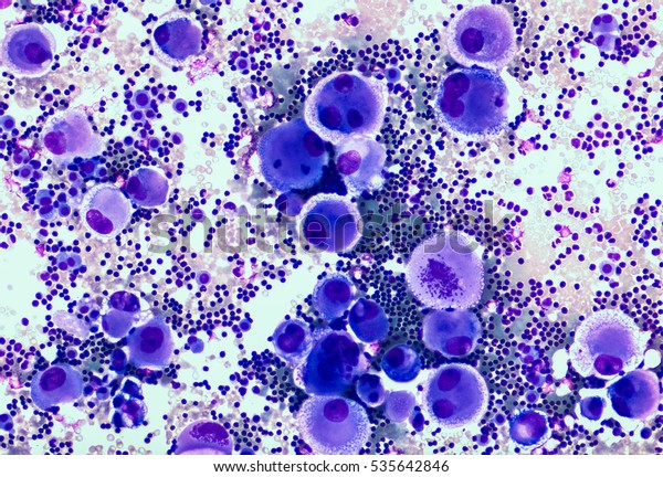 Malignant Fluid Cytology Malignant Cells Adenocarcinoma Stock Photo ...