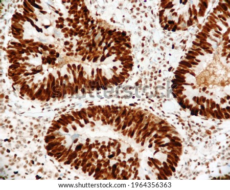 Malignant glands of a colon cancer with strong brown expression of the mismatch repair protein called MSH2. Microscopic view. Immunohistochemistry. Stock foto © 