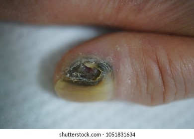 Malignant Melanoma Of The Nail