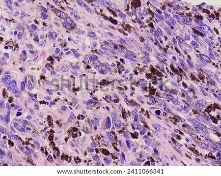 Malignant Melanoma. Malignant Skin Tumor. we see here there is melanotic pigment in the tumor cells.