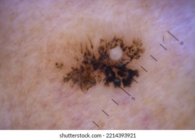 A Malignant Tumor Of The Human Skin Is Melanoma