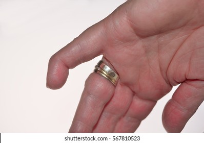 A Mallet Finger A Deformity Of The Little  Finger Caused When The Tendon That Straightens Your Finger (the Extensor Tendon) Is Damaged. Sometimes Called Chamber Maids Finger.