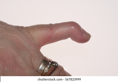 A Mallet Finger A Deformity Of The Little  Finger Caused When The Tendon That Straightens Your Finger (the Extensor Tendon) Is Damaged. Sometimes Called Chamber Maids Finger.