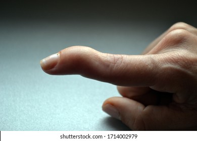 Mallet Finger Injury Or Baseball Finger Injury On Gray Background