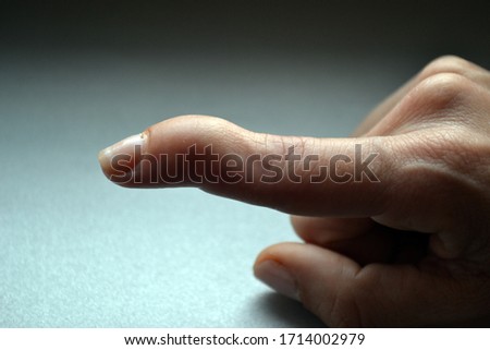 Mallet finger injury or baseball finger injury on gray background