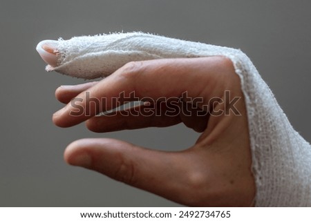 Mallet finger, stack splint on the middle finger with bandage to immobilize the last phalanx following joint trauma
