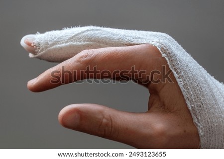 Mallet finger, stack splint on the middle finger with bandage to immobilize the last phalanx following joint trauma