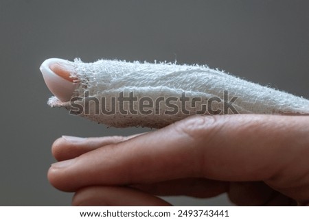 Mallet finger, stack splint on the middle finger with bandage to immobilize the last phalanx following joint trauma