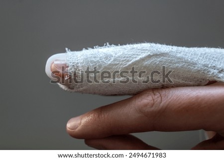 Mallet finger, stack splint on the middle finger with bandage to immobilize the last phalanx following joint trauma