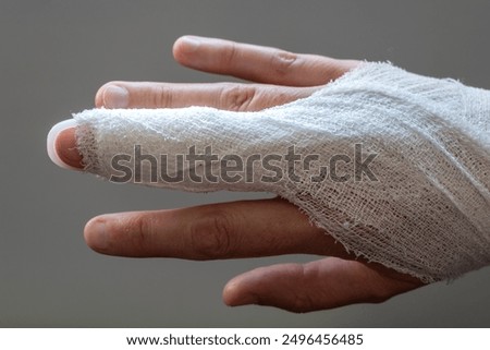 Mallet finger, stack splint on the middle finger with bandage to immobilize the last phalanx following joint trauma