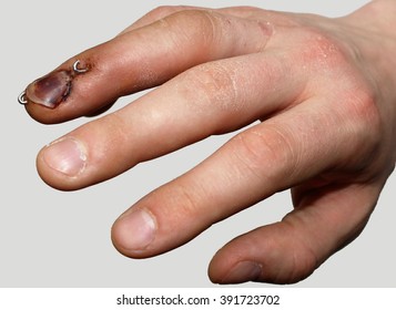 Mallet Finger Surgery Treatment. Human Injury Hand Finger.