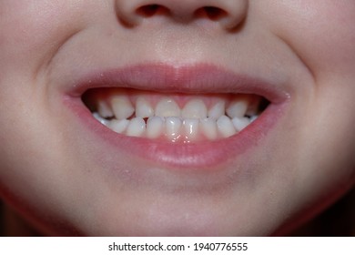 Malocclusion of a child, close-up on the front teeth of a child.