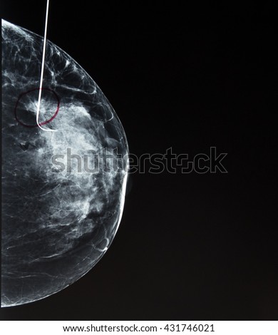 localized breast biopsy Stories grandma deepthroats