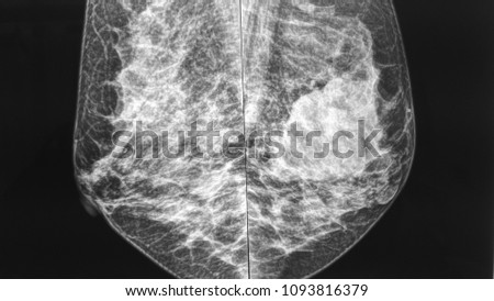 Mammography image of left breast showing hyperdense lesion suggestive of cancer.