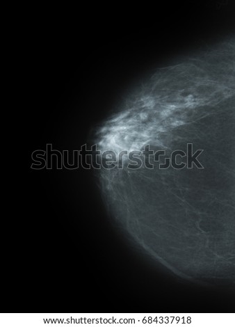 a Mammography picture - x-ray of Breast