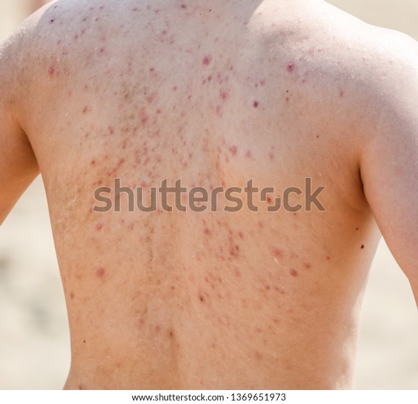 Man Acne On His Back Stock Photo 1369651973 | Shutterstock