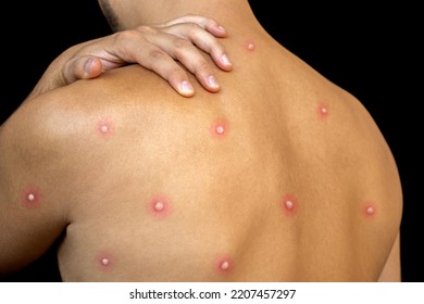 Man Affected By New Monkeypox Dangerous Disease On His Back With Painful Rash And Blisters . Person With Itch Red Spots On The Skin With Monkey Smallpox Close Up