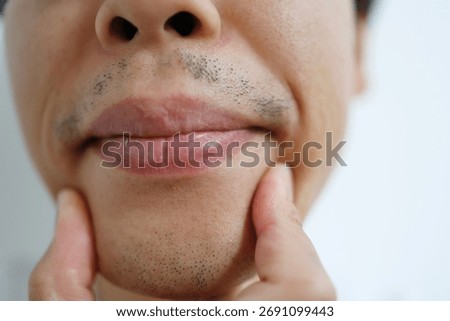 A man after five beard removal sessions. The patchy beard remaining around his mouth and chin.